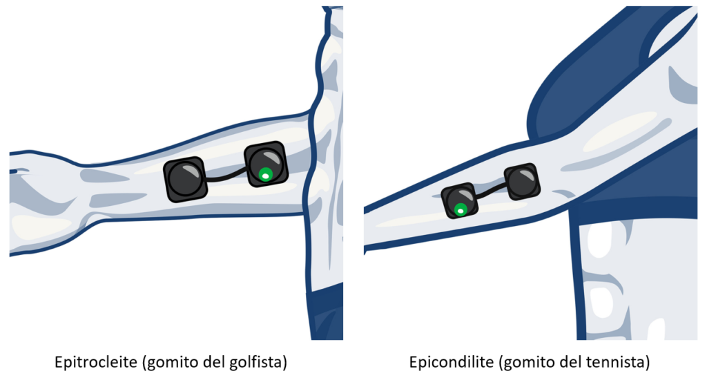 epicondilite ed epitrocleite: posizionamento elettrodi per programma antidolore