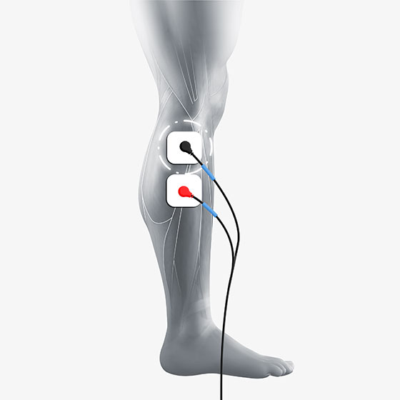 Foot Muscle Electrode Placement for Compex Muscle Stimulators 